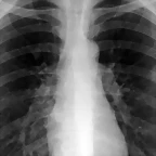 Hipertensin Pulmonar Enfermedad mortal y casi desconocida