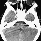 Abuso TAC Hemorragia retiniana 1