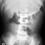 Absceso apendicularRx