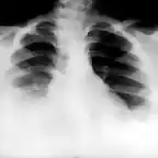 Derrame pleural bilateral