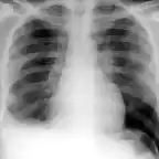 Derrame pleural der