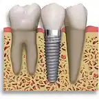implantes-dentales-de-titanio