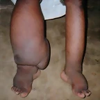filariasis