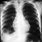 Infiltrado pulmonar agudo Rx 1