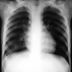 Infiltrado pulmonar agudo Rx 72hs