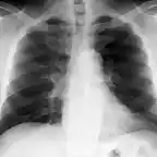 Asbestos Reaccion pleural mnima