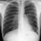 Bronquiectasias S Basal post Izq Rx f