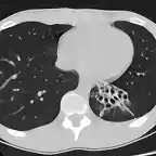 Bronquiectasias S Basal post Izq TAC1