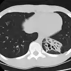 Bronquiectasias S Basal post Izq TAC2