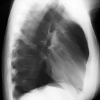 neumoperitoneominimo en RX de Torax P