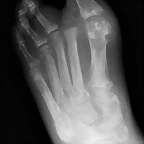 gout-plain-radiograph