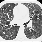 HemosiderosisTAC