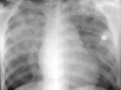 Edema alveolar no cardiogenico