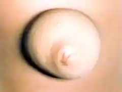 Hernia Umbilical Clinica