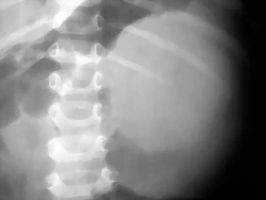 Neuroblastoma retroperitoneal Rx