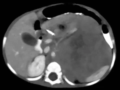 Neuroblastoma TAC