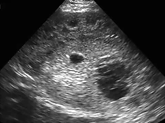 Neuroblastoma US