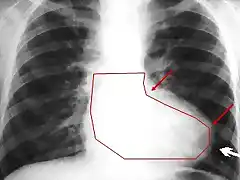 radiografia_tetralogia_Fallot