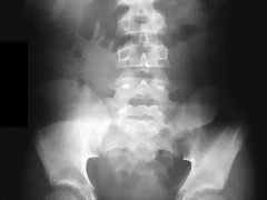 Borramiento psoas Rx