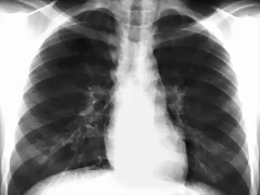 Neumomediastino enfisema cuello Rx F