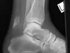 calcaneal-avulsion