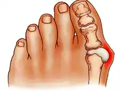 Juanetes-Hallux-Valgus-Deformidad-Dedo-Gordo (1)