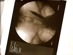 stenosis 2