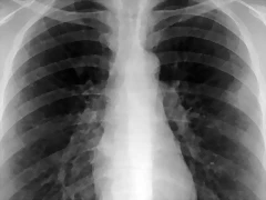 Hipertensin Pulmonar Enfermedad mortal y casi desconocida