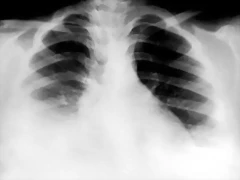 Derrame pleural bilateral