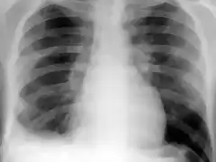 Derrame pleural der