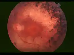 800px-Fundus_of_patient_with_retinitis_pigmentosa,_mid_stage