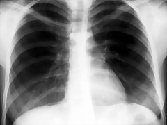 neumoperitoneominimo en RX de Torax F