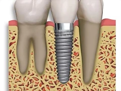 implantes-dentales-de-titanio