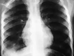 Infiltrado pulmonar agudo Rx 1