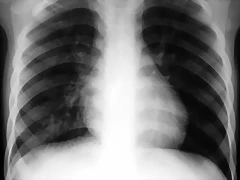 Infiltrado pulmonar agudo Rx 72hs