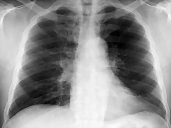 Asbestos Reaccion pleural mnima