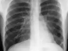 Bronquiectasias S Basal post Izq Rx f