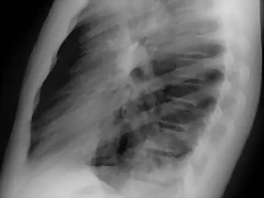 Bronquiectasias S Basal post Izq Rx p