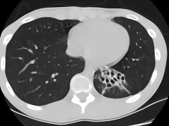 Bronquiectasias S Basal post Izq TAC1