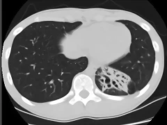 Bronquiectasias S Basal post Izq TAC2