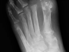 gout-plain-radiograph