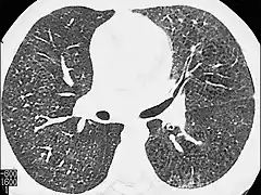 HemosiderosisTAC